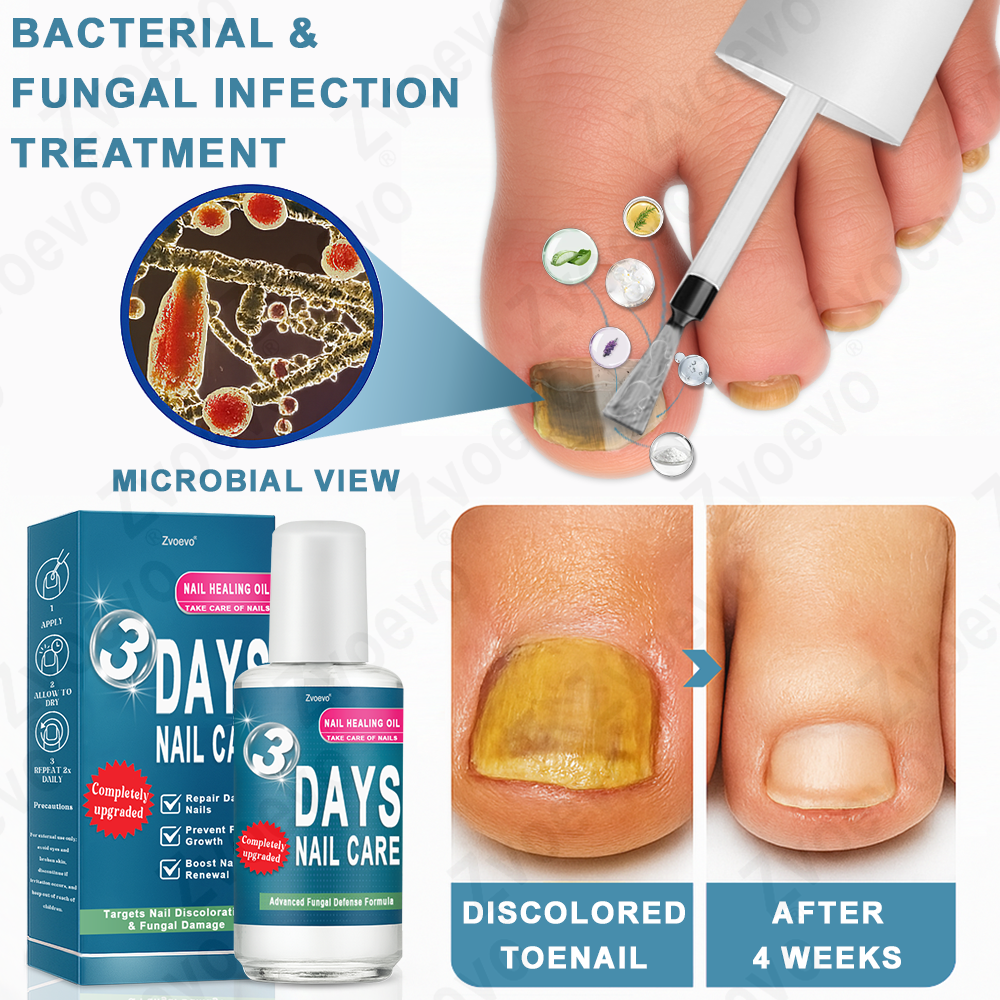 ✅ Official Store: Zvoevo® KERA3+ Nail Repair Serum👨⚕️FDA Approved (Nail fungus, fungal infection, yellow or discolored nails, thickened and deformed nails)