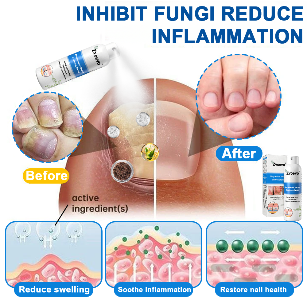 -50%OFF(🌲Early Christmas Sale🎁) Zvoevo® Magnesium Herbal Psoriasis Spray 👨⚕️ FDA Approved (Relieves psoriasis and eczema, improves bacterial infections in the genital area, hidradenitis suppurativa)