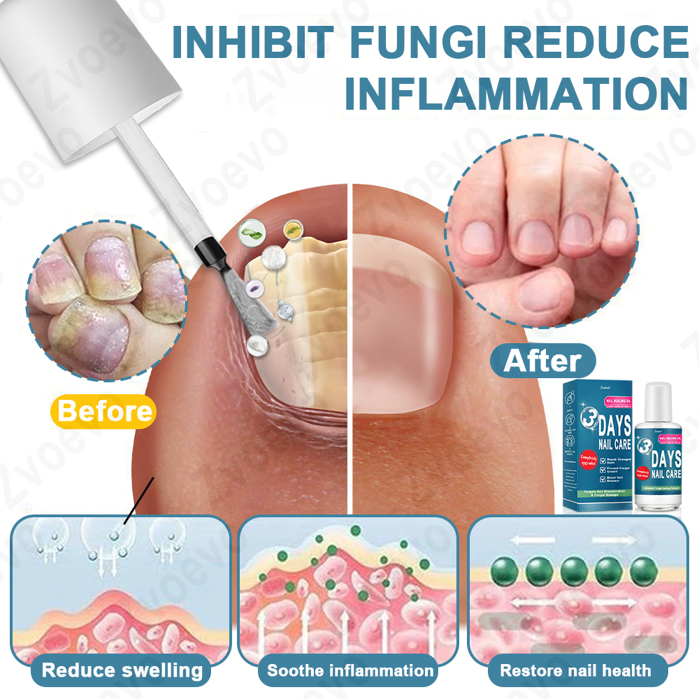 ✅ Official Store: Zvoevo® KERA3+ Nail Repair Serum👨⚕️FDA Approved (Nail fungus, fungal infection, yellow or discolored nails, thickened and deformed nails)