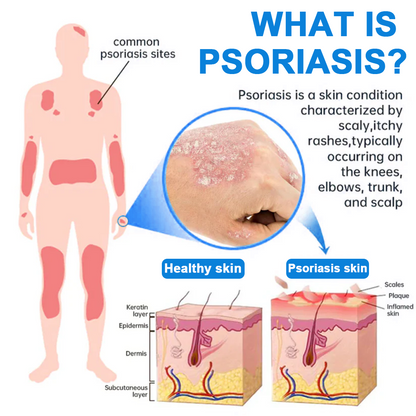 ✅ Official Store: Zvoevo® Magnesium Herbal Psoriasis Spray ⚕️ FDA Approved (Relieves Psoriasis and Eczema, Treats Bacterial Infections in the Genital Area, Eases Psoriatic Arthritis)