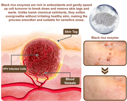 Zvoevo® Black Rice Skin Repair Cream 👨‍⚕️ FDA Approved (for removing warts, skin growths, scar repair, senile purpura)