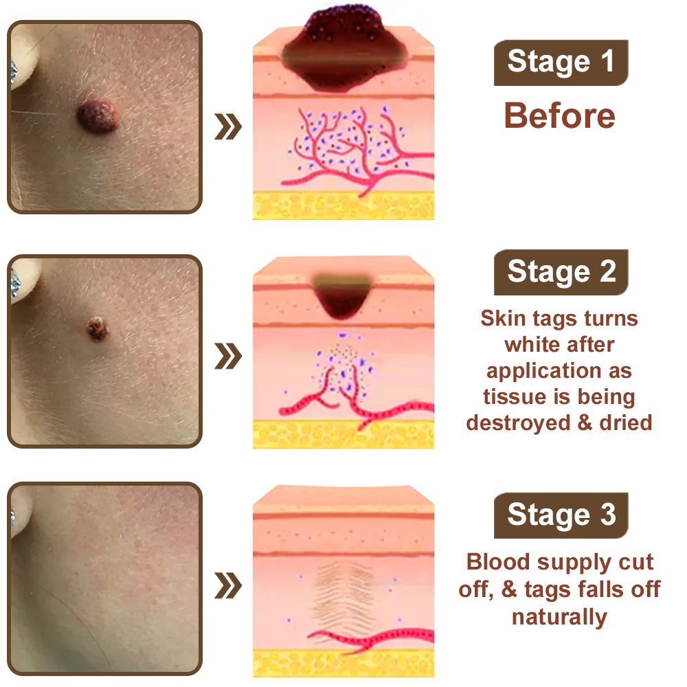 Zvoevo® Black Rice Skin Repair Cream 👨‍⚕️ FDA Approved (for removing warts, skin growths, scar repair, senile purpura)