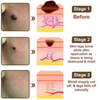 Zvoevo® Black Rice Skin Repair Cream 👨‍⚕️ FDA Approved (for removing warts, skin growths, scar repair, senile purpura)