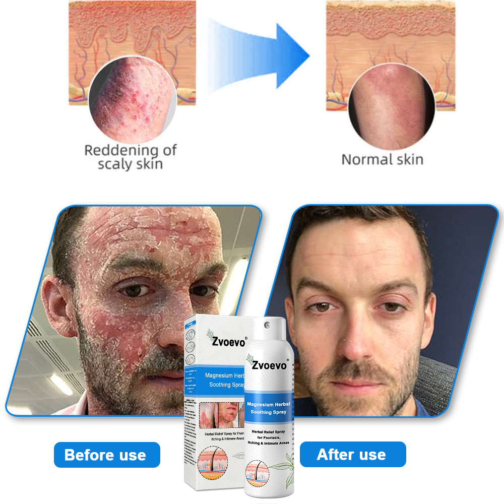 ✅ Official Store: Zvoevo® Magnesium Herbal Psoriasis Spray ⚕️ FDA Approved (Relieves Psoriasis and Eczema, Treats Bacterial Infections in the Genital Area, Eases Psoriatic Arthritis)