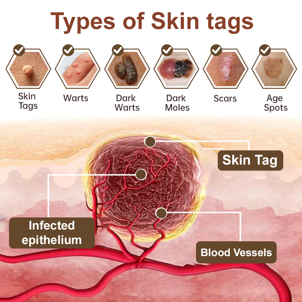 Zvoevo® Black Rice Skin Repair Cream 👨‍⚕️ FDA Approved (for removing warts, skin growths, scar repair, senile purpura)