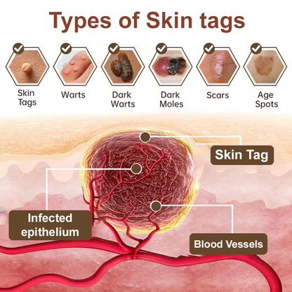 Zvoevo® Black Rice Skin Repair Cream 👨‍⚕️ FDA Approved (for removing warts, skin growths, scar repair, senile purpura)