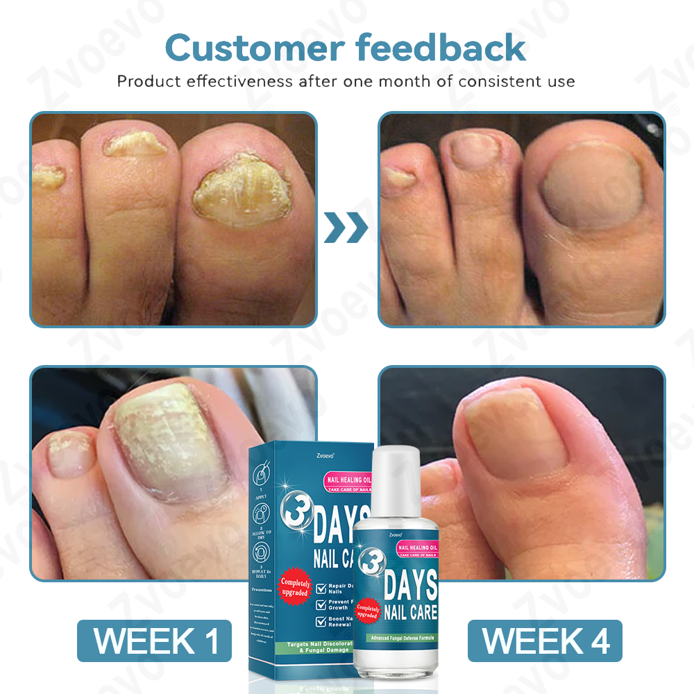 ✅ Official Store: Zvoevo® KERA3+ Nail Repair Serum👨‍⚕️FDA Approved (Antifungal solution for toenails and fingernails)