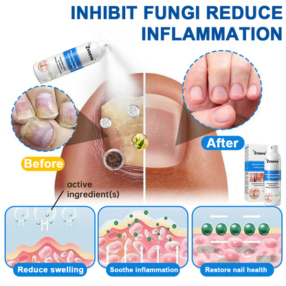 ✅ Official Store: Zvoevo® Magnesium Herbal Psoriasis Spray ⚕️ FDA Approved (Relieves Psoriasis and Eczema, Treats Bacterial Infections in the Genital Area, Eases Psoriatic Arthritis)